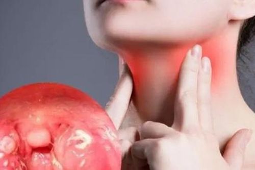 Viêm họng cấp có thể gây ra biến chứng gì?