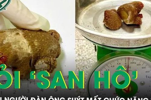 Sỏi 'san hô' trong thận suốt 20 năm, người đàn ông suýt mất chức năng thận