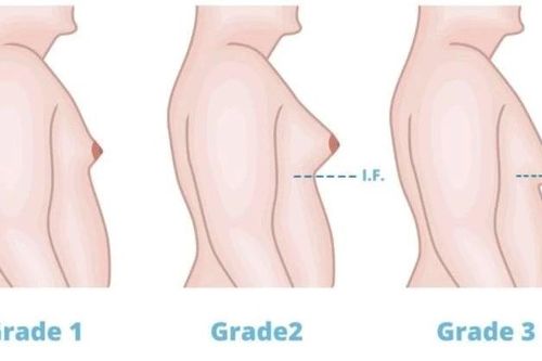 Nam giới phì đại tuyến vú, cẩn thận ung thư