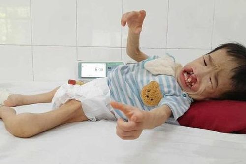 Bé gái 3 tuổi có khuôn mặt biến dạng vì dị tật mong chờ cơ hội được phẫu thuật