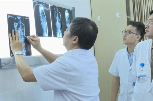 Khoảng 80% trẻ cong vẹo cột sống không rõ nguyên nhân