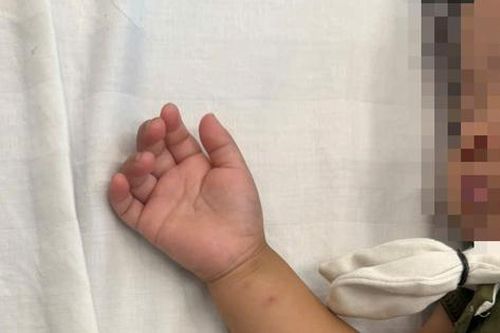 Bé gái hơn 2 tuổi nhập viện gấp do tai nạn tại nhà hay gặp ở trẻ nhỏ
