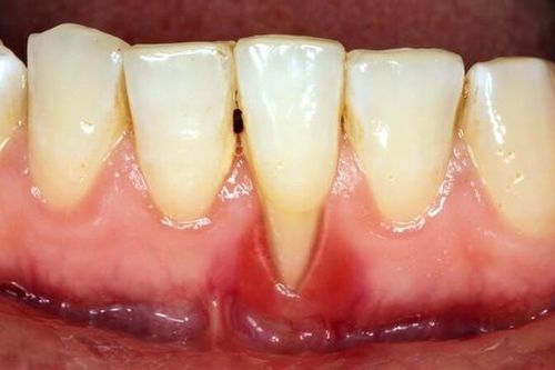 Ám ảnh tụt nướu: Dấu hiệu, nguyên nhân và 'lá chắn' bảo vệ nụ cười