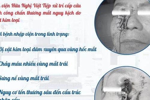 Hải Phòng: Xử trí thành công ca chấn thương mắt nguy kịch do dị vật kim loại