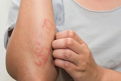 Giun lươn trong cơ thể nguy hiểm hơn ngoài da
