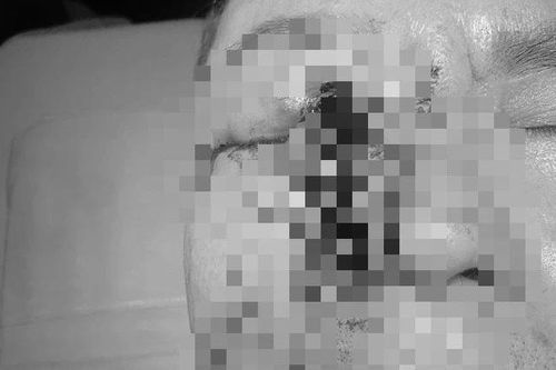 Cấp cứu kịp thời cho nam giới bị dị vật kim loại đâm vào mắt