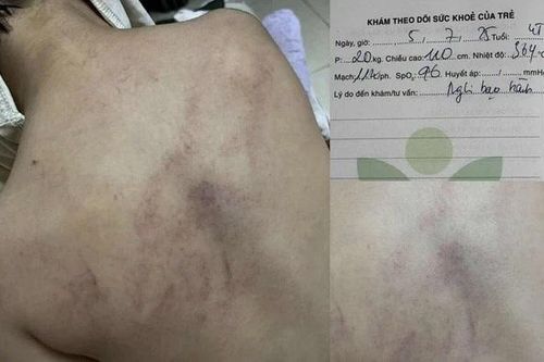 Bộ Y tế thông tin vụ nghi trẻ bị bạo hành tại Bồ Đề, Hà Nội
