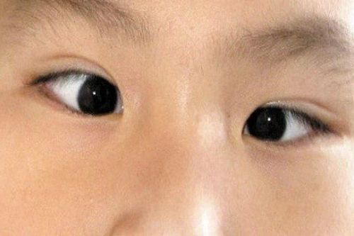 Chứng lác mắt ở trẻ tăng do sử dụng thiết bị điện tử