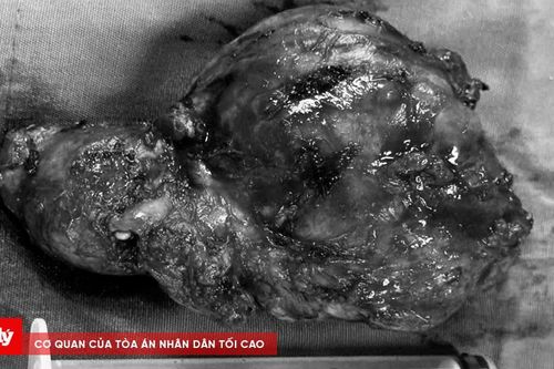 Phẫu thuật thành công khối u tuyến giáp 'khủng' cho cụ bà 93 tuổi