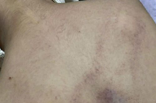 Bộ Y tế vào cuộc, trưng cầu giám định bé 4 tuổi bị cô giáo bạo hành