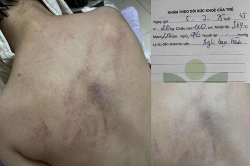 Hội BVQTE Việt Nam đề nghị khẩn trương làm rõ việc phụ huynh tố giáo viên bạo hành trẻ mầm non 4 tuổi
