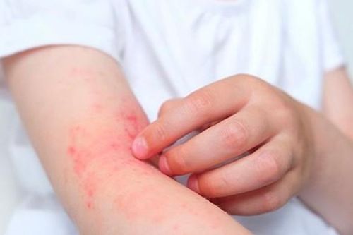 Bài thuốc điều trị viêm da cơ địa