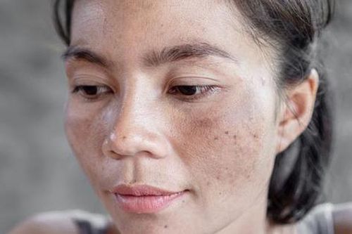 7 vấn đề về da mùa hè có thể ngăn ngừa
