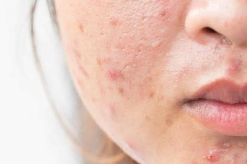Thực phẩm dễ gây mụn trứng cá