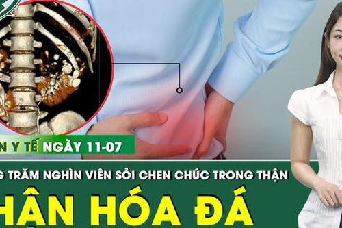 Bản tin Y tế 11/7: Hai bên thận người đàn ông bị bịt kín bởi hàng trăm nghìn viên sỏi