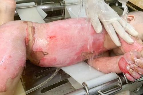 Bé 2 tuổi bỏng 60% được cứu sống nhờ ghép da từ mẹ