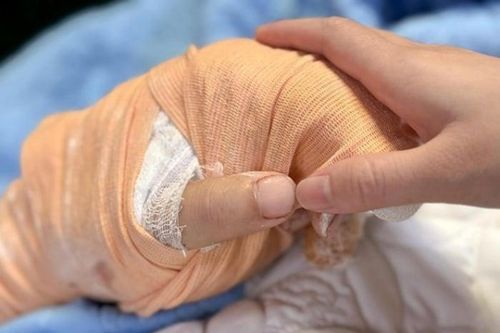 Truyền 2,5 lít máu nối bàn tay bị chém gần đứt cho nam thanh niên ở Thái Nguyên