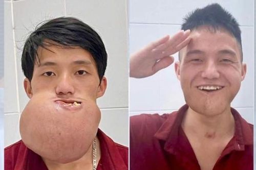 Ca phẫu thuật kéo dài 10 giờ tìm lại nụ cười cho chàng trai trẻ