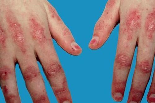 Chăm sóc, theo dõi bệnh viêm da cơ, viêm đa cơ cần lưu ý gì?