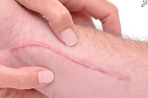 Kiêng gì để tránh bị sẹo lồi?