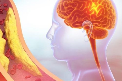 7 triệu chứng thường thấy ở người bị thiếu máu lên não