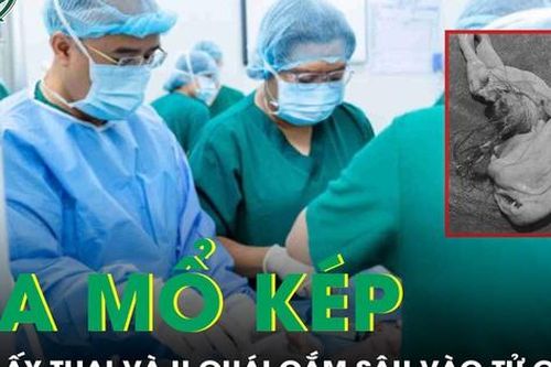 Mổ lấy thai cho sản phụ, bác sĩ phát hiện u quái cắm sâu vào eo tử cung