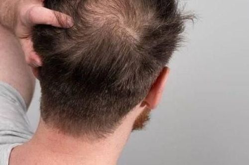 Dùng thuốc gây rụng tóc, chữa thế nào?