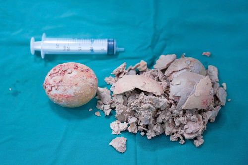 Bệnh viện Hùng Vương Gia Lai phẫu thuật thành công sỏi bàng quang 'khổng lồ' hơn 10cm