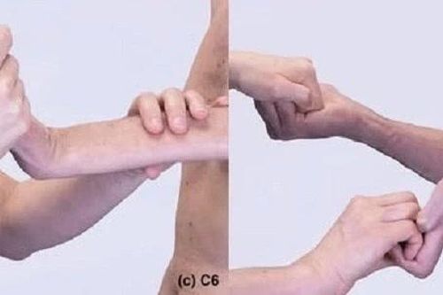 Cách điều trị liệt đám rối thần kinh cánh tay