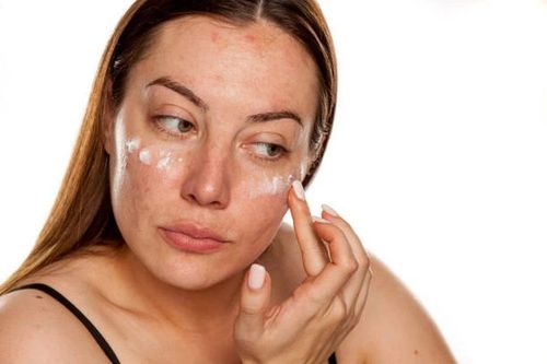 Vì sao nám da dễ tái phát sau khi đã điều trị thành công?