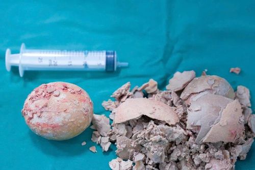 Bệnh viện Hùng Vương Gia Lai phẫu thuật lấy viên sỏi bàng quang 'khổng lồ'