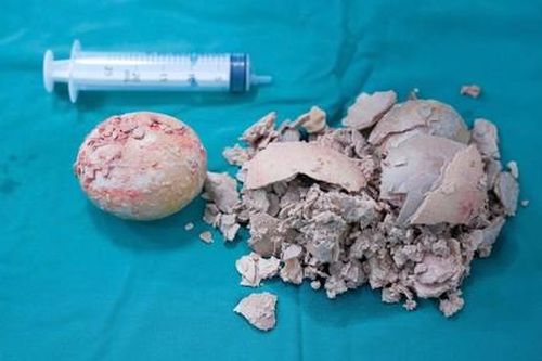 Lấy viên sỏi bàng quang đường kính 10cm cho nữ bệnh nhân 36 tuổi