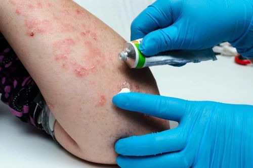 Thuốc điều trị bệnh vảy nến ở phụ nữ