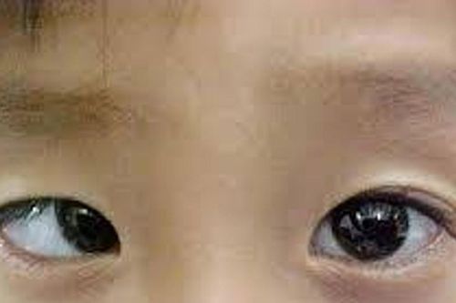 Lác mắt - đừng chỉ nghĩ tới thẩm mỹ
