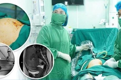 Nội soi bóc khối u xơ tử cung 'khủng' cho bệnh nhân 24 tuổi