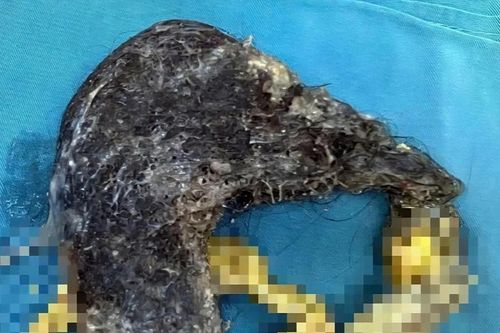 Búi tóc nặng nửa cân trong bụng bé trai 5 tuổi