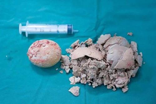 Lấy thành công viên sỏi 'khổng lồ' nằm trong cơ thể người bệnh gần 30 năm