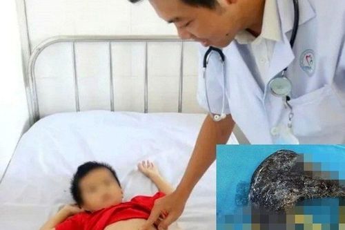 Bé trai 5 tuổi nhập viện vì đau bụng, bác sĩ sững sờ khi phát hiện dị vật này