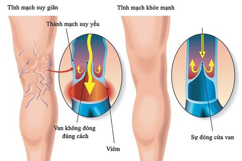 Bệnh suy tĩnh mạch mạn tính nguy hiểm thế nào?