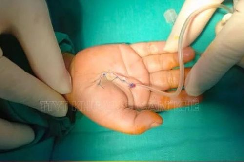 Bé 4 tuổi đứt phức tạp gân các ngón tay do mảnh cốc vỡ