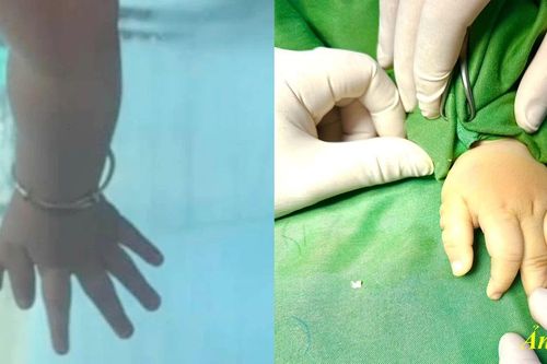 Dị tật bẩm sinh ngón tay thừa gây mất chức năng vận động
