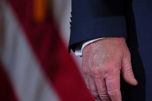 Bệnh suy tĩnh mạch mà Tổng thống Mỹ Donald Trump mắc phải có nguy hiểm không?