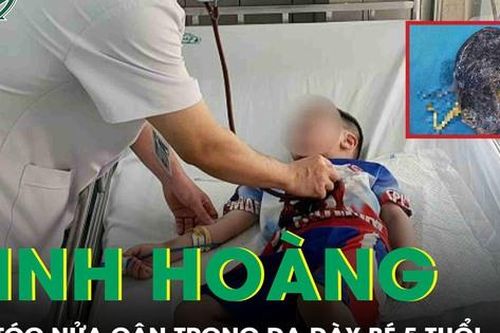 Lấy búi tóc nặng nửa cân trong dạ dày bé trai 5 tuổi