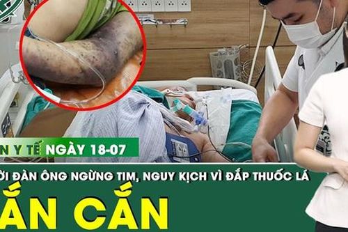 Bản Tin Y Tế 18/7: Bị rắn hổ mang chúa cắn, người đàn ông ngừng tim, hôn mê sau đắp thuốc lá