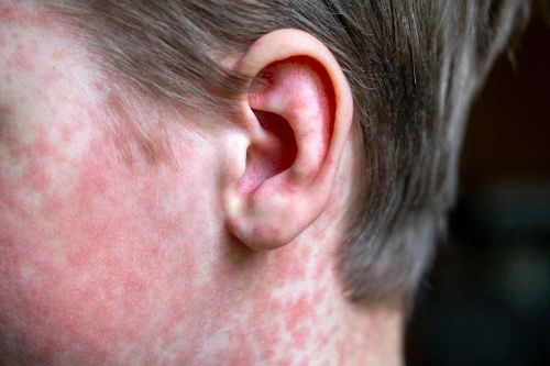 Biến chứng nguy hiểm có thể gặp sau khi mắc sởi