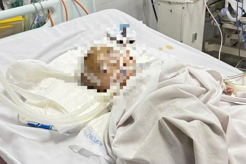 Bé 1 tuổi bị xuất huyết não bất thường tại điểm trông trẻ tự phát