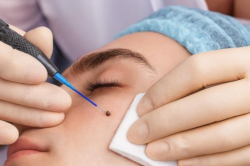 Có nên phẫu thuật tẩy nốt ruồi?