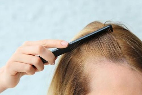 Dấu hiệu nhận biết sớm hói đầu và những lầm tưởng phổ biến