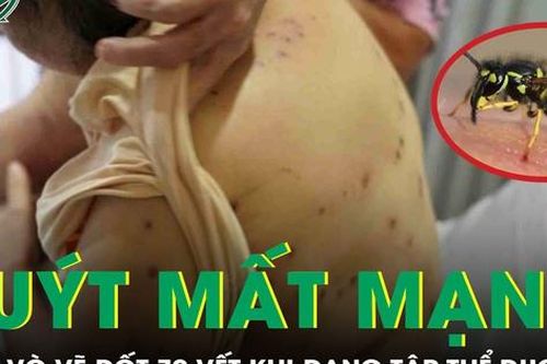 Ong vò vẽ đốt 70 vết khi đang tập thể dục, người phụ nữ suýt mất mạng
