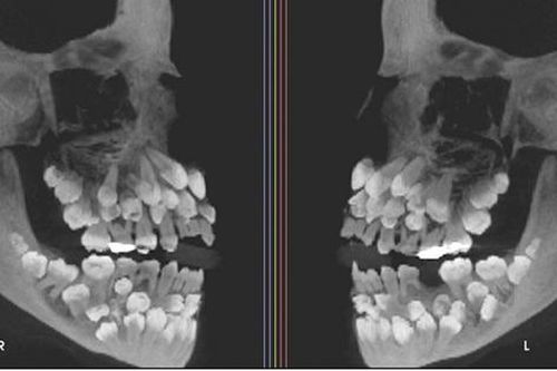 Đi nhổ răng sữa, bé gái khiến nha sĩ sốc nặng khi có 81 chiếc răng